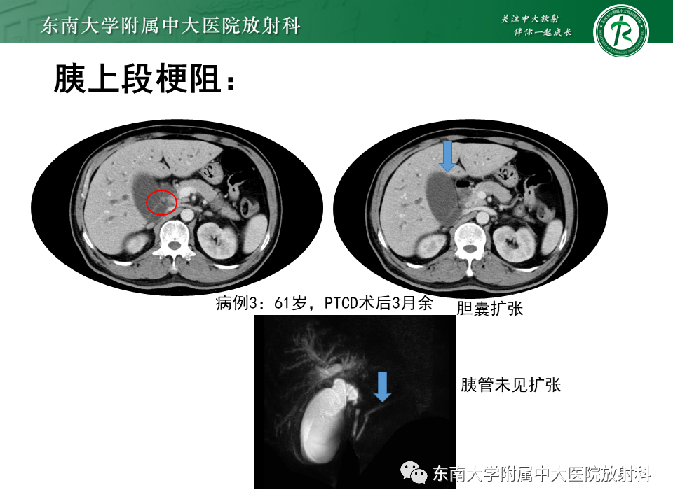 影像PPT - 【PPT】恶性胆道梗阻疾病影像诊断思路-22