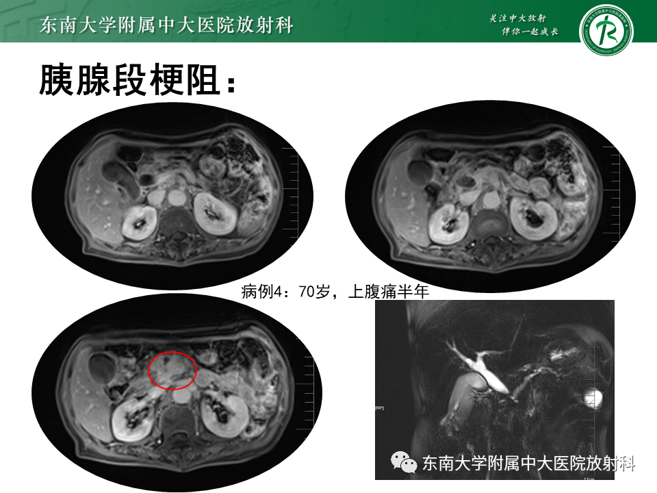 影像PPT - 【PPT】恶性胆道梗阻疾病影像诊断思路-23