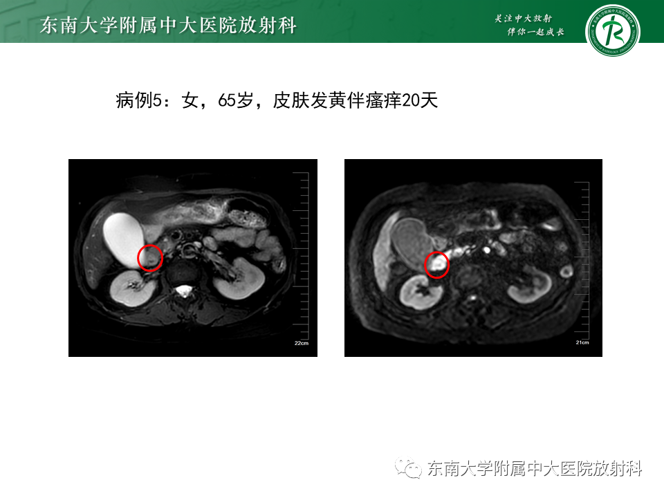 影像PPT - 【PPT】恶性胆道梗阻疾病影像诊断思路-24
