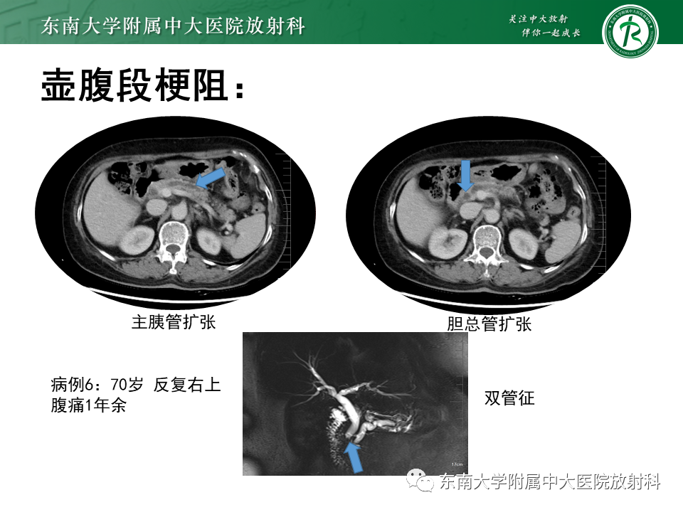 影像PPT - 【PPT】恶性胆道梗阻疾病影像诊断思路-27