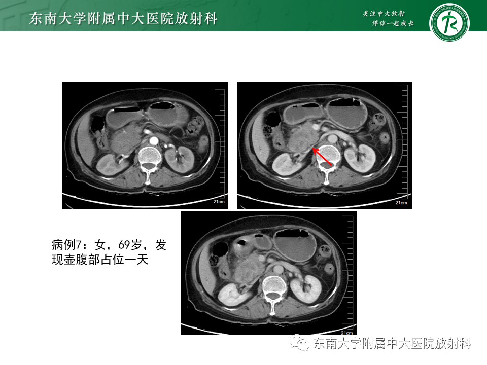 影像PPT - 【PPT】恶性胆道梗阻疾病影像诊断思路-28