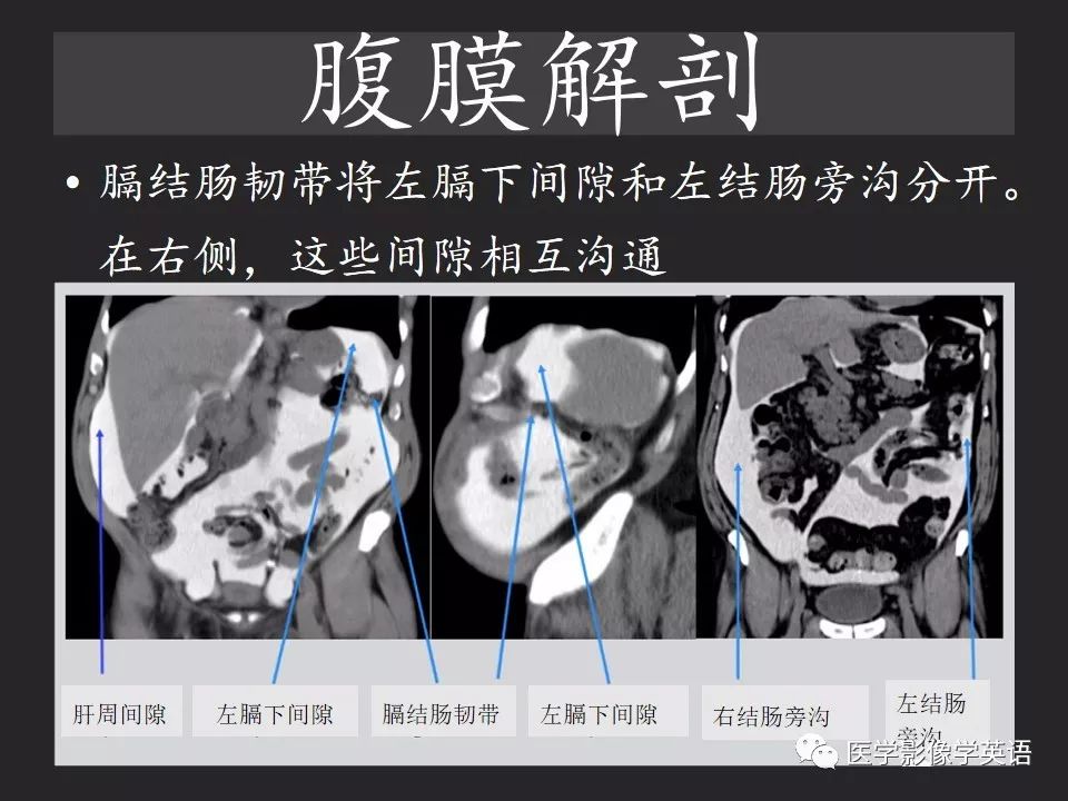 影像PPT - 【PPT】腹腔游离气体:从哪里来?如何应用腹膜解剖确定穿孔部位-11 影像PPT - 【PPT】腹腔游离气体:从哪里来?如何应用腹膜解剖确定穿孔部位-11