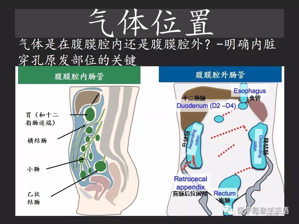 影像PPT - 【PPT】腹腔游离气体:从哪里来?如何应用腹膜解剖确定穿孔部位-15 影像PPT - 【PPT】腹腔游离气体:从哪里来?如何应用腹膜解剖确定穿孔部位-15