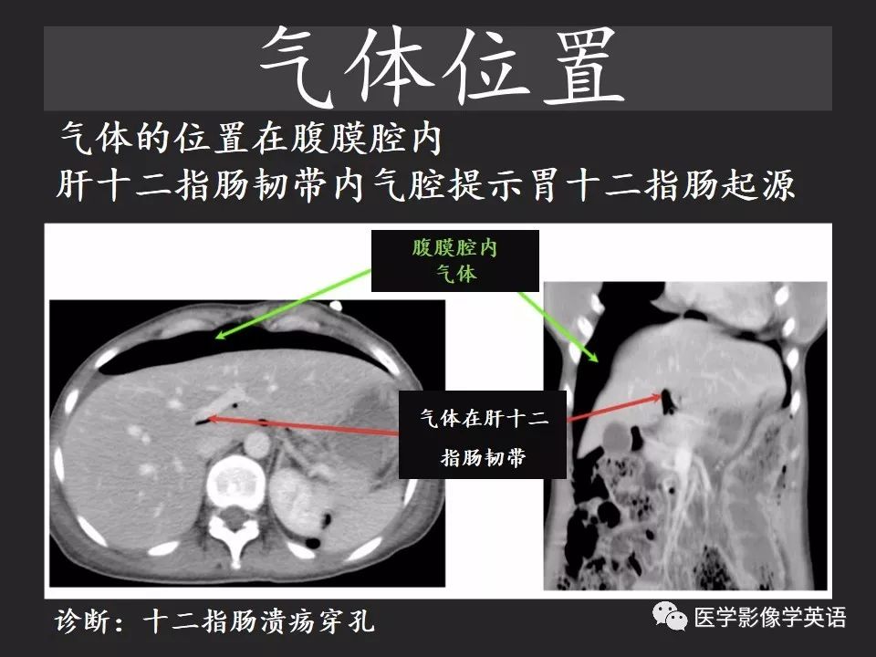 影像PPT - 【PPT】腹腔游离气体:从哪里来?如何应用腹膜解剖确定穿孔部位-16 影像PPT - 【PPT】腹腔游离气体:从哪里来?如何应用腹膜解剖确定穿孔部位-16