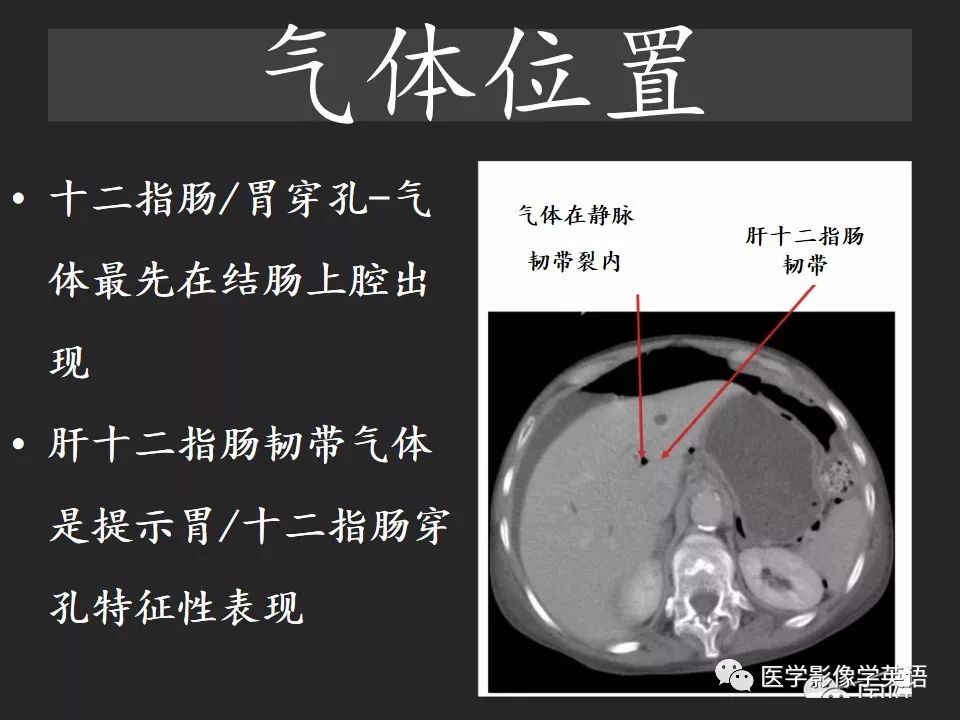 影像PPT - 【PPT】腹腔游离气体:从哪里来?如何应用腹膜解剖确定穿孔部位-17 影像PPT - 【PPT】腹腔游离气体:从哪里来?如何应用腹膜解剖确定穿孔部位-17