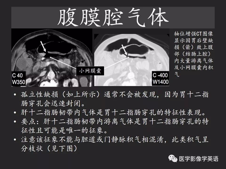 影像PPT - 【PPT】腹腔游离气体:从哪里来?如何应用腹膜解剖确定穿孔部位-18 影像PPT - 【PPT】腹腔游离气体:从哪里来?如何应用腹膜解剖确定穿孔部位-18