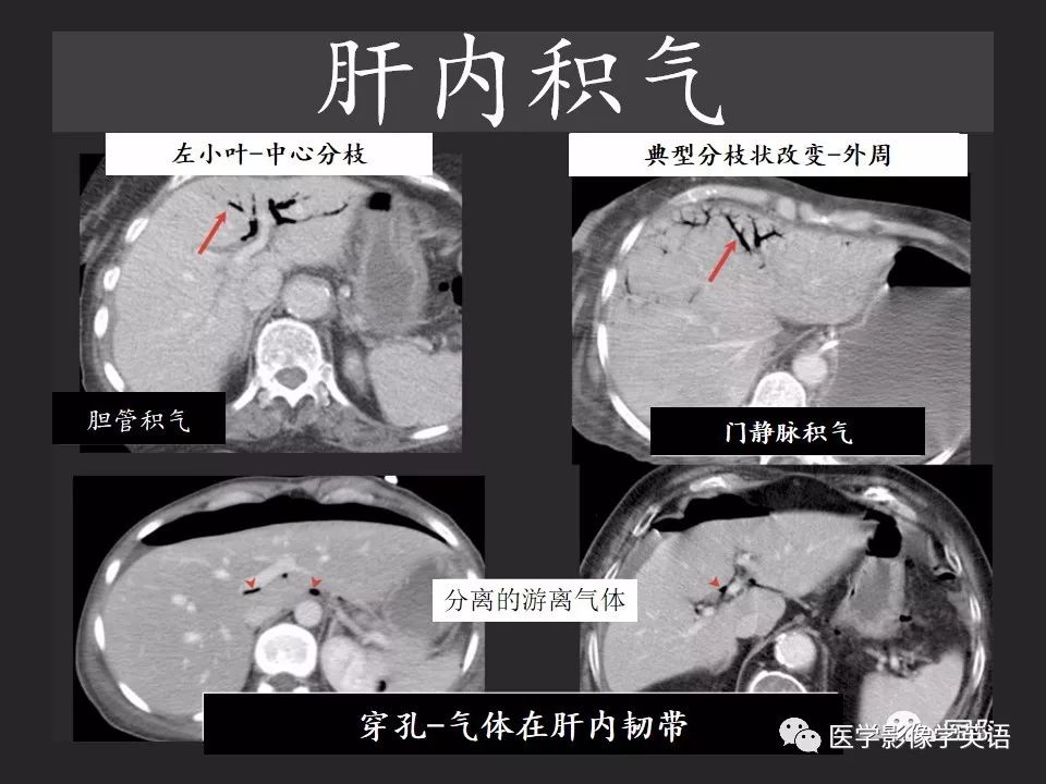 影像PPT - 【PPT】腹腔游离气体:从哪里来?如何应用腹膜解剖确定穿孔部位-19 影像PPT - 【PPT】腹腔游离气体:从哪里来?如何应用腹膜解剖确定穿孔部位-19