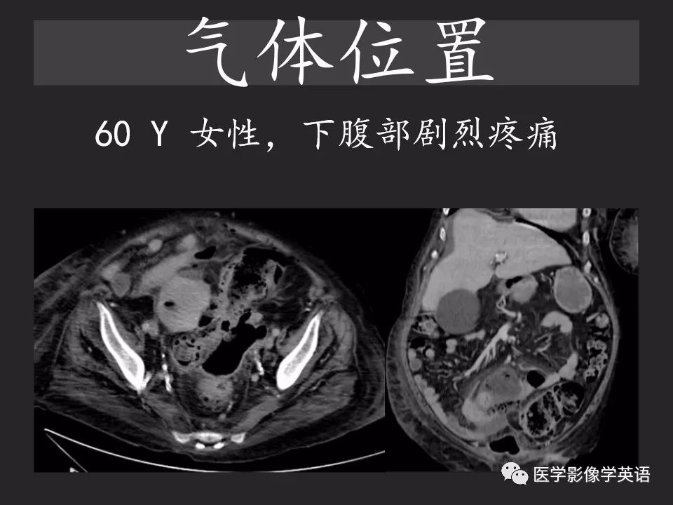 影像PPT - 【PPT】腹腔游离气体:从哪里来?如何应用腹膜解剖确定穿孔部位-20 影像PPT - 【PPT】腹腔游离气体:从哪里来?如何应用腹膜解剖确定穿孔部位-20