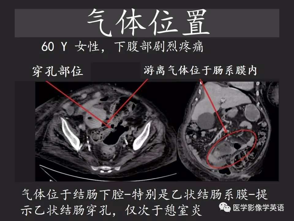 影像PPT - 【PPT】腹腔游离气体:从哪里来?如何应用腹膜解剖确定穿孔部位-21 影像PPT - 【PPT】腹腔游离气体:从哪里来?如何应用腹膜解剖确定穿孔部位-21