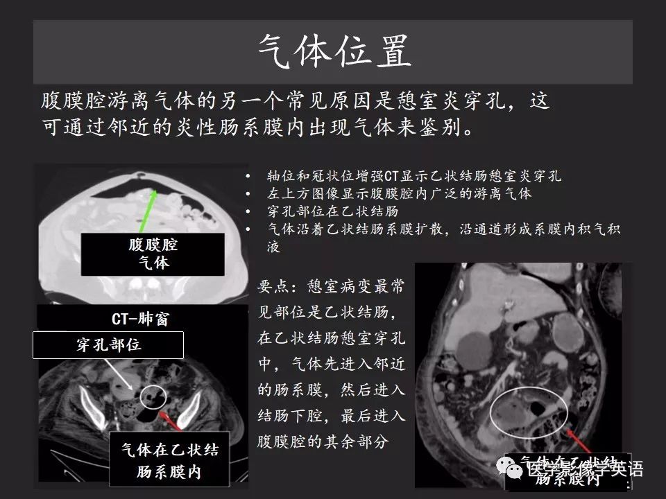 影像PPT - 【PPT】腹腔游离气体:从哪里来?如何应用腹膜解剖确定穿孔部位-22 影像PPT - 【PPT】腹腔游离气体:从哪里来?如何应用腹膜解剖确定穿孔部位-22
