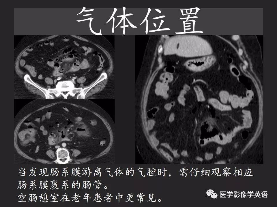影像PPT - 【PPT】腹腔游离气体:从哪里来?如何应用腹膜解剖确定穿孔部位-23 影像PPT - 【PPT】腹腔游离气体:从哪里来?如何应用腹膜解剖确定穿孔部位-23