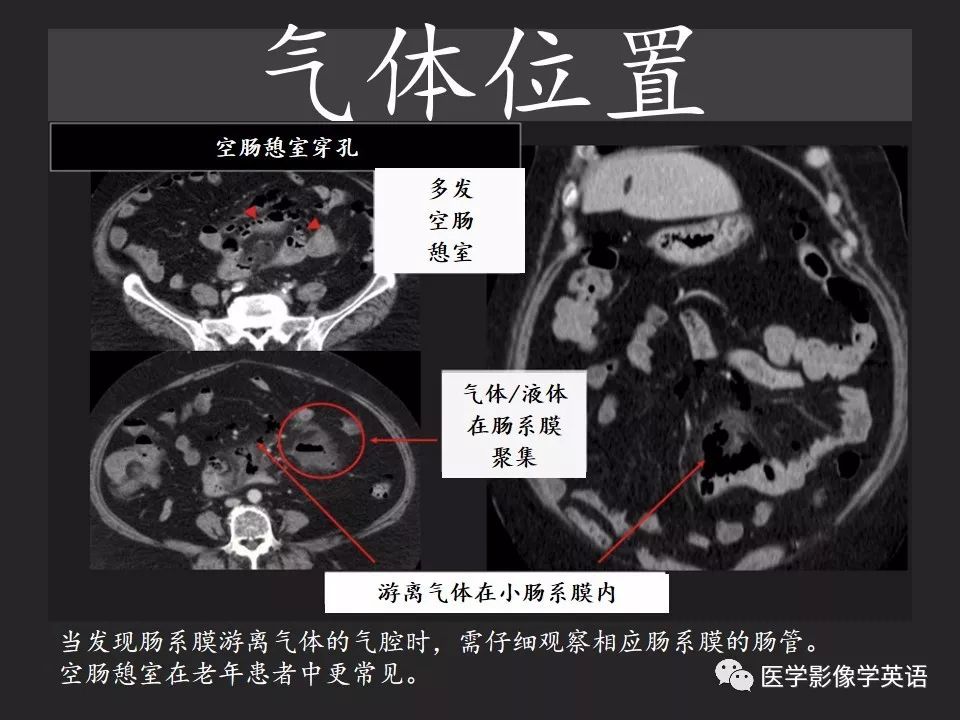 影像PPT - 【PPT】腹腔游离气体:从哪里来?如何应用腹膜解剖确定穿孔部位-24 影像PPT - 【PPT】腹腔游离气体:从哪里来?如何应用腹膜解剖确定穿孔部位-24