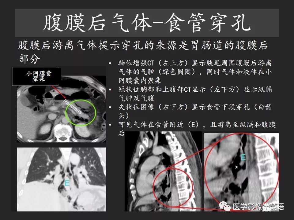 影像PPT - 【PPT】腹腔游离气体:从哪里来?如何应用腹膜解剖确定穿孔部位-25 影像PPT - 【PPT】腹腔游离气体:从哪里来?如何应用腹膜解剖确定穿孔部位-25