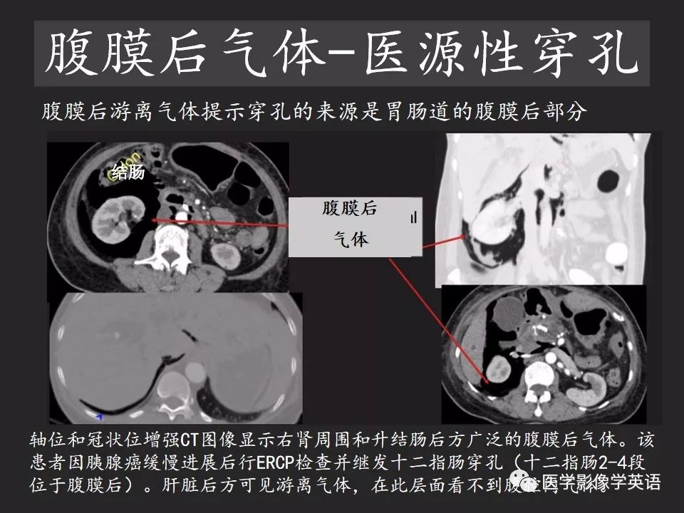 影像PPT - 【PPT】腹腔游离气体:从哪里来?如何应用腹膜解剖确定穿孔部位-27 影像PPT - 【PPT】腹腔游离气体:从哪里来?如何应用腹膜解剖确定穿孔部位-27