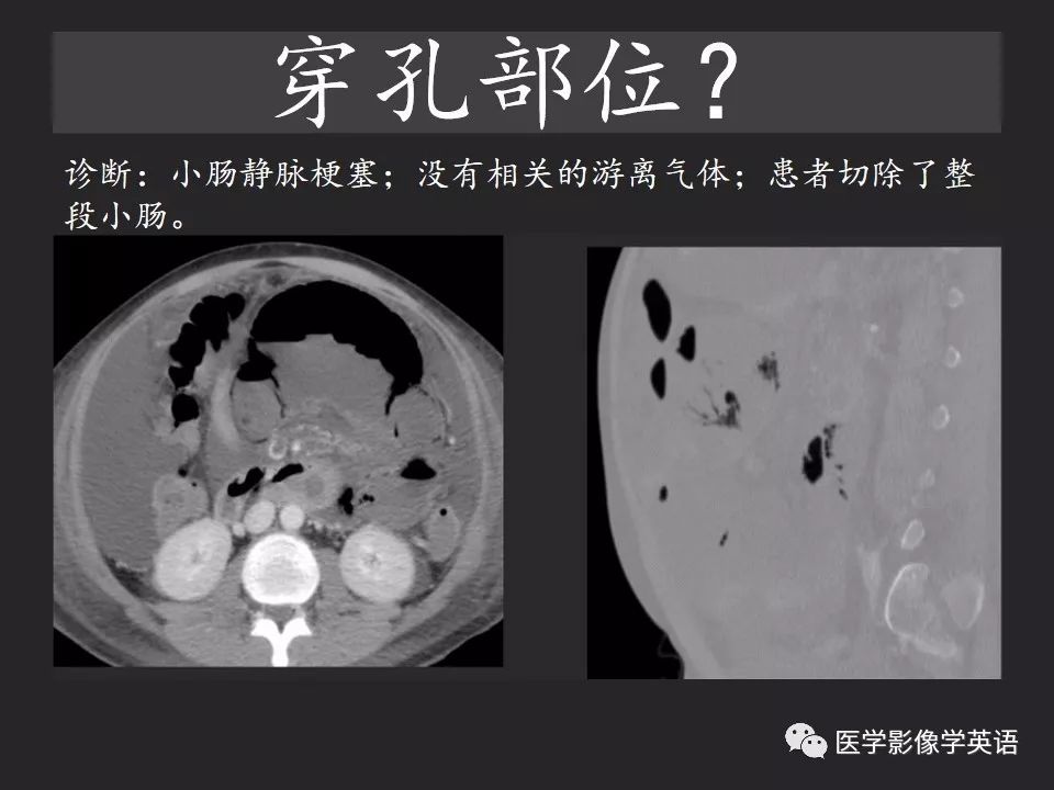 影像PPT - 【PPT】腹腔游离气体:从哪里来?如何应用腹膜解剖确定穿孔部位-28 影像PPT - 【PPT】腹腔游离气体:从哪里来?如何应用腹膜解剖确定穿孔部位-28
