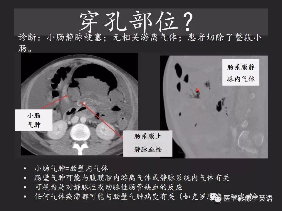 影像PPT - 【PPT】腹腔游离气体:从哪里来?如何应用腹膜解剖确定穿孔部位-29 影像PPT - 【PPT】腹腔游离气体:从哪里来?如何应用腹膜解剖确定穿孔部位-29