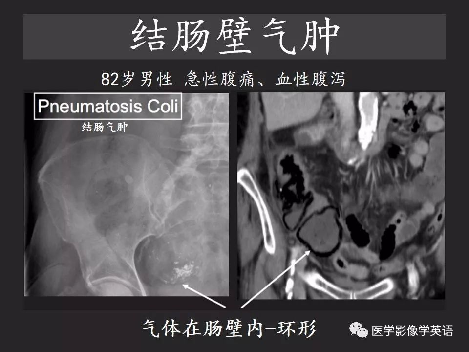 影像PPT - 【PPT】腹腔游离气体:从哪里来?如何应用腹膜解剖确定穿孔部位-30 影像PPT - 【PPT】腹腔游离气体:从哪里来?如何应用腹膜解剖确定穿孔部位-30