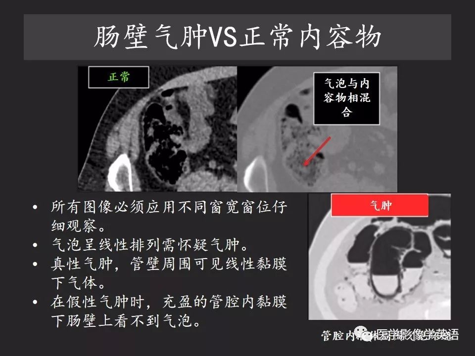 影像PPT - 【PPT】腹腔游离气体:从哪里来?如何应用腹膜解剖确定穿孔部位-31 影像PPT - 【PPT】腹腔游离气体:从哪里来?如何应用腹膜解剖确定穿孔部位-31