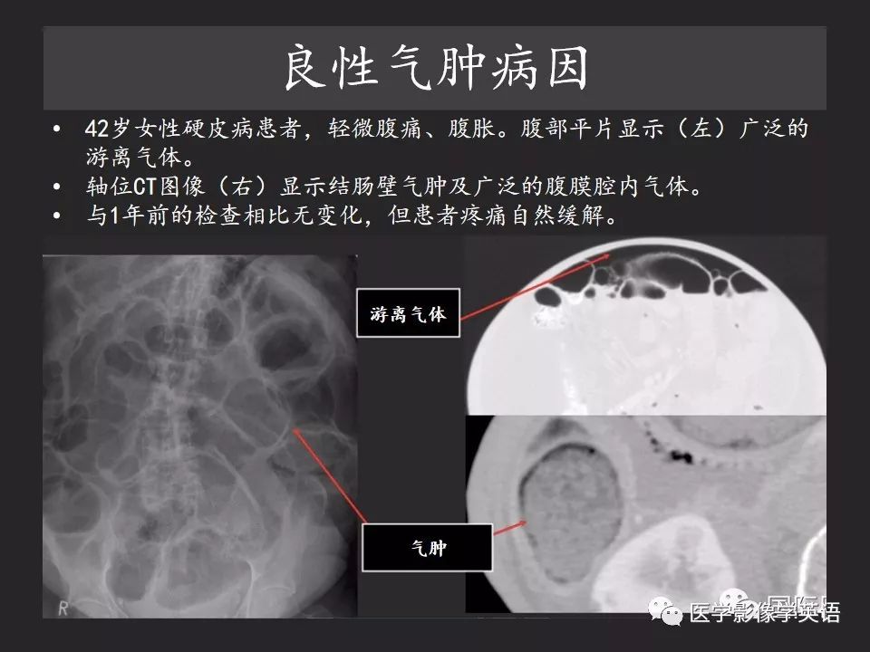 影像PPT - 【PPT】腹腔游离气体:从哪里来?如何应用腹膜解剖确定穿孔部位-32 影像PPT - 【PPT】腹腔游离气体:从哪里来?如何应用腹膜解剖确定穿孔部位-32