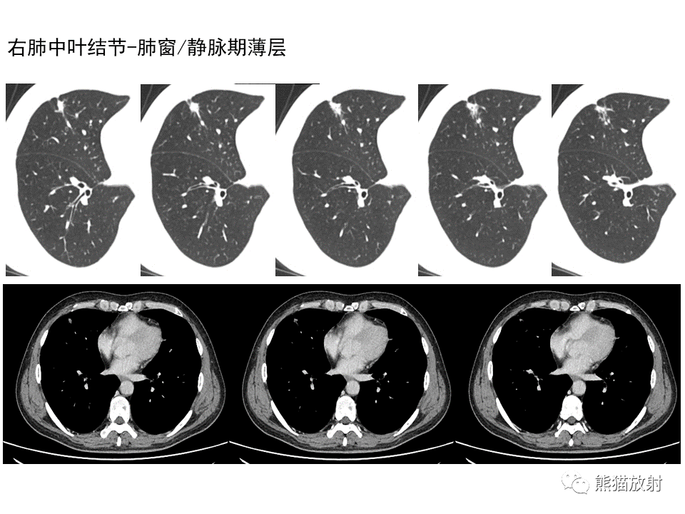 影像PPT - 【病例】局灶性机化性肺炎2例CT影像诊断-12