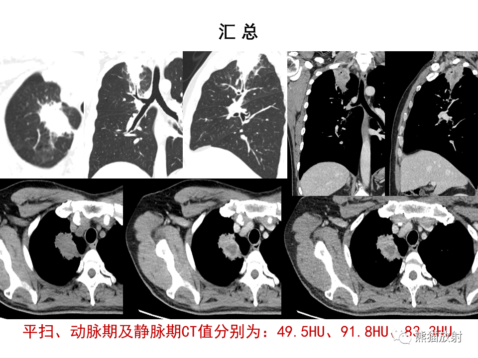 影像PPT - 【病例】局灶性机化性肺炎2例CT影像诊断-13
