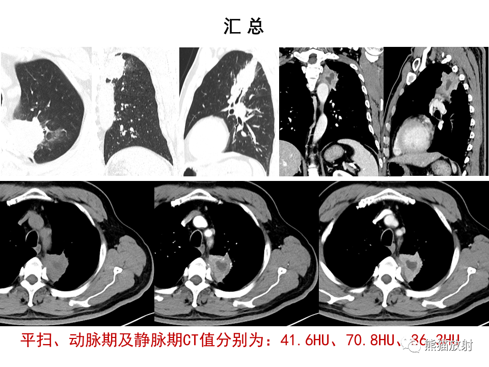 影像PPT - 【病例】局灶性机化性肺炎2例CT影像诊断-25