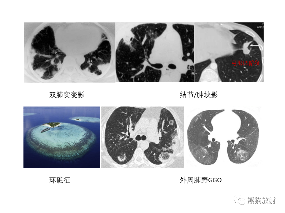 影像PPT - 【病例】局灶性机化性肺炎2例CT影像诊断-33