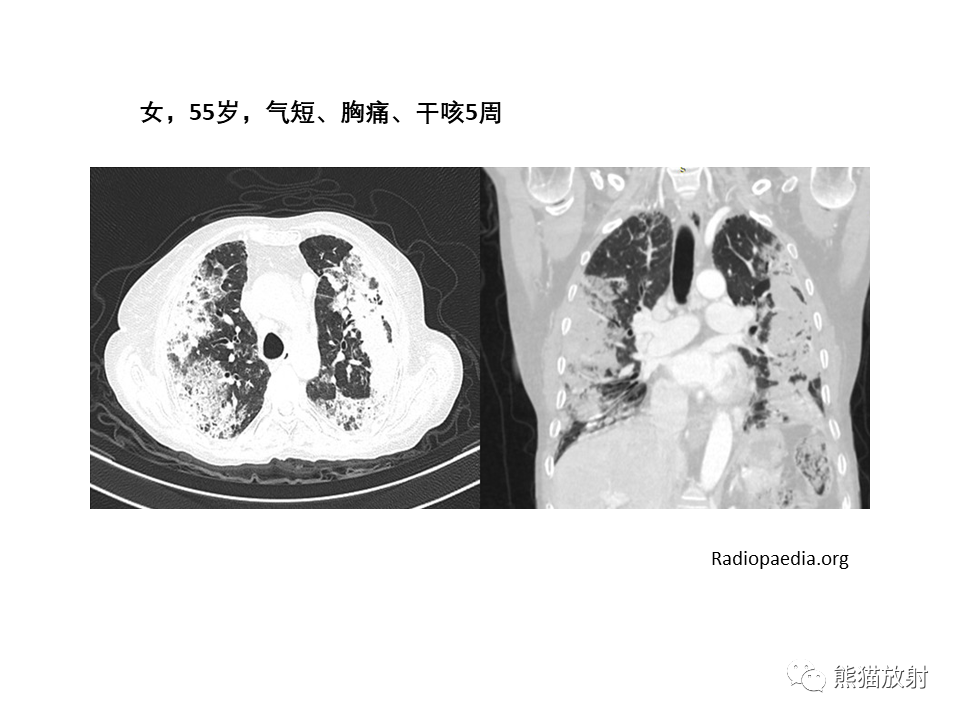 影像PPT - 【病例】局灶性机化性肺炎2例CT影像诊断-34
