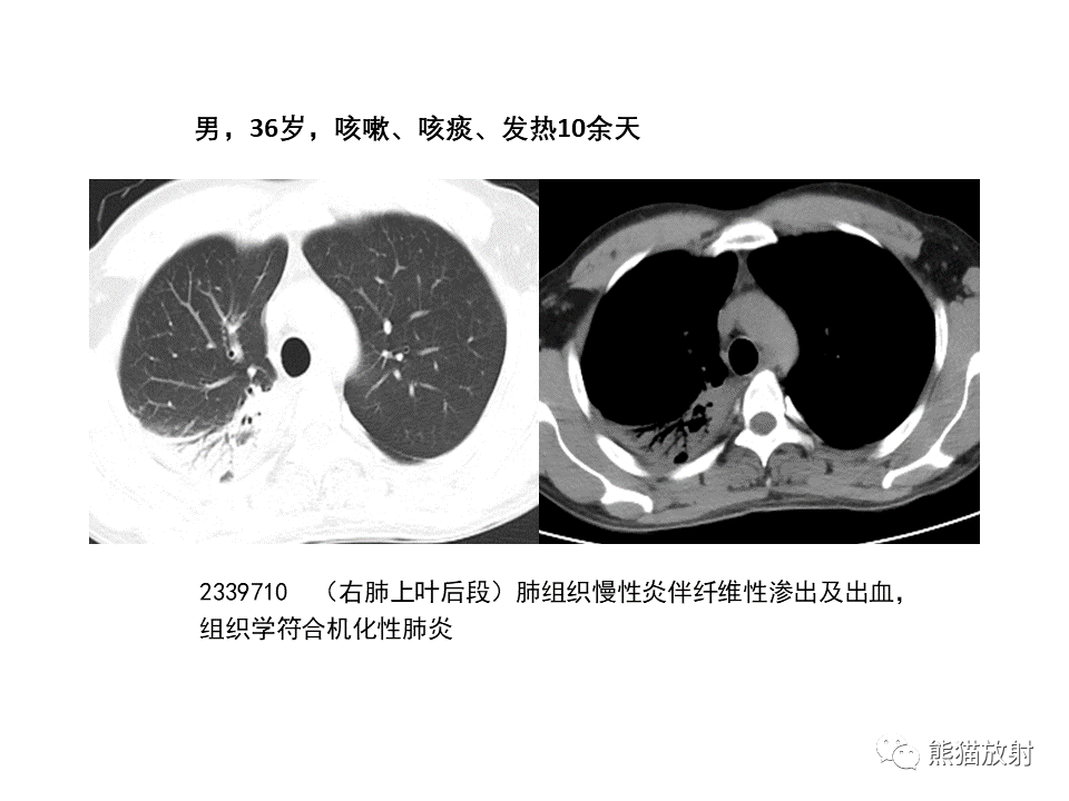 影像PPT - 【病例】局灶性机化性肺炎2例CT影像诊断-35