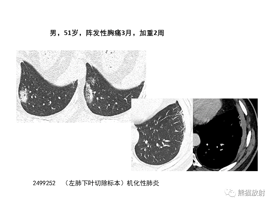 影像PPT - 【病例】局灶性机化性肺炎2例CT影像诊断-36