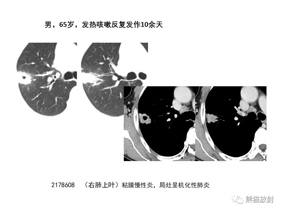 影像PPT - 【病例】局灶性机化性肺炎2例CT影像诊断-37