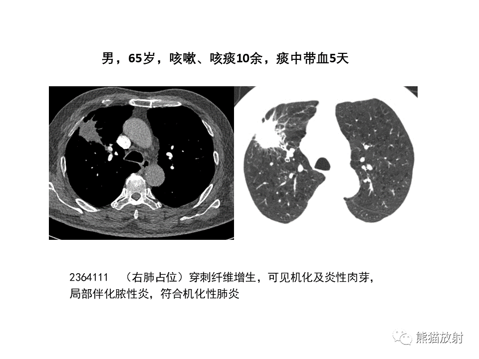影像PPT - 【病例】局灶性机化性肺炎2例CT影像诊断-38
