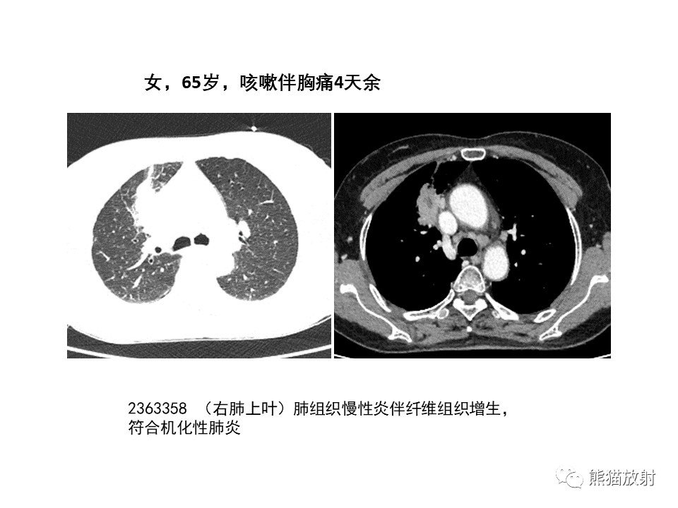 影像PPT - 【病例】局灶性机化性肺炎2例CT影像诊断-39