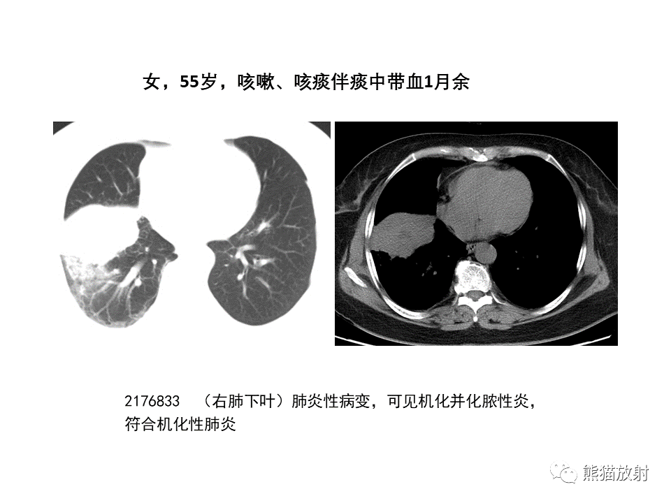 影像PPT - 【病例】局灶性机化性肺炎2例CT影像诊断-40
