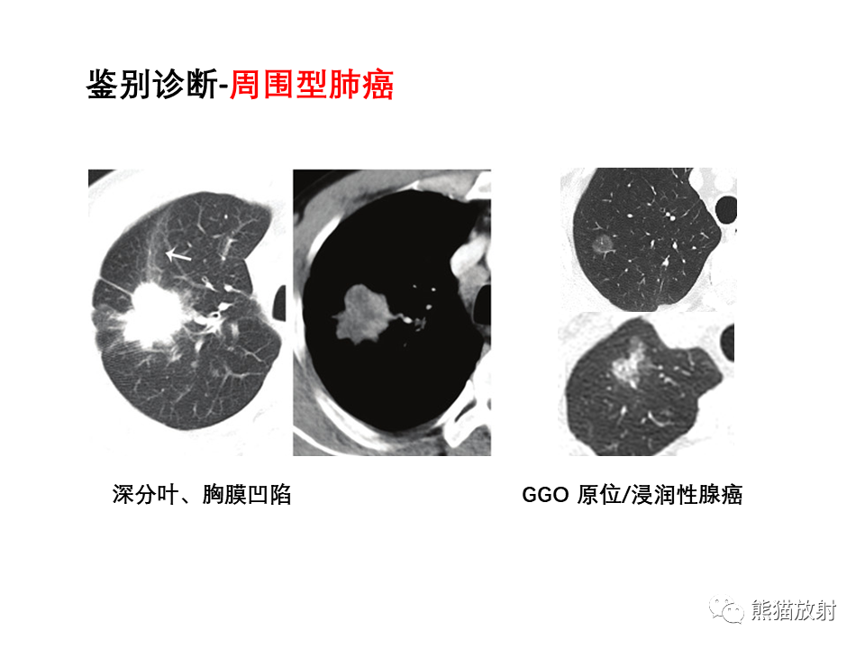 影像PPT - 【病例】局灶性机化性肺炎2例CT影像诊断-41