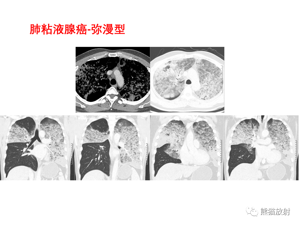 影像PPT - 【病例】局灶性机化性肺炎2例CT影像诊断-42