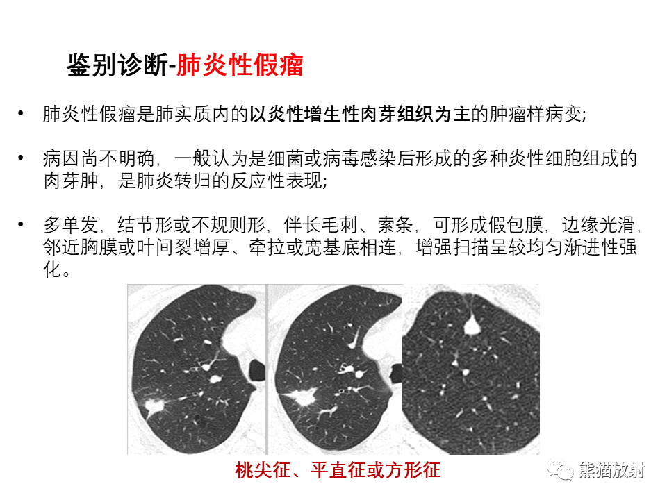 影像PPT - 【病例】局灶性机化性肺炎2例CT影像诊断-43