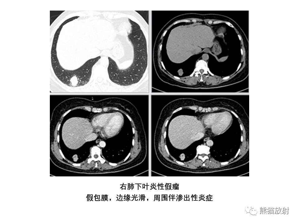 影像PPT - 【病例】局灶性机化性肺炎2例CT影像诊断-44