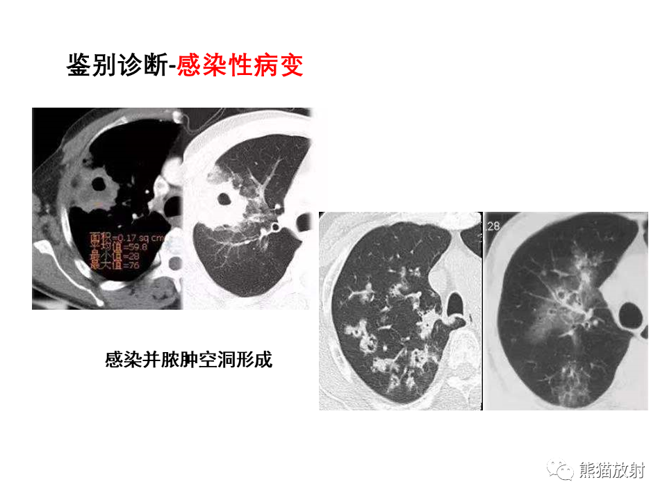 影像PPT - 【病例】局灶性机化性肺炎2例CT影像诊断-45