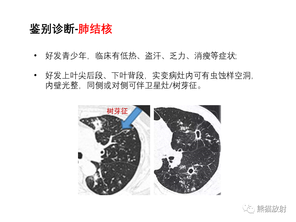 影像PPT - 【病例】局灶性机化性肺炎2例CT影像诊断-46