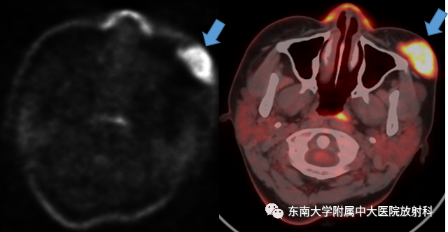 影像PPT - 【病例】颌面部恶性黑色素瘤1例MR影像-2