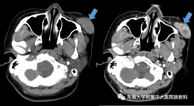 影像PPT - 【病例】颌面部恶性黑色素瘤1例MR影像-3