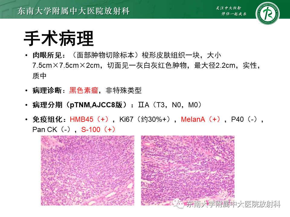 影像PPT - 【病例】颌面部恶性黑色素瘤1例MR影像-5