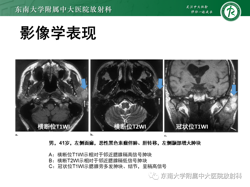 影像PPT - 【病例】颌面部恶性黑色素瘤1例MR影像-12