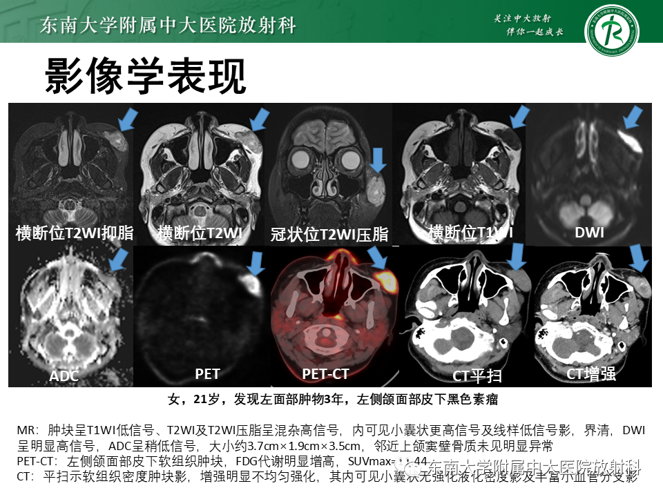影像PPT - 【病例】颌面部恶性黑色素瘤1例MR影像-13