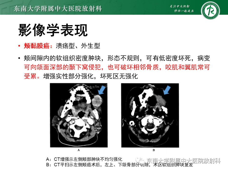 影像PPT - 【病例】颌面部恶性黑色素瘤1例MR影像-15