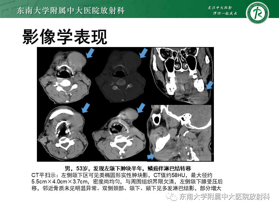 影像PPT - 【病例】颌面部恶性黑色素瘤1例MR影像-16