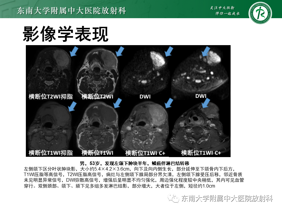 影像PPT - 【病例】颌面部恶性黑色素瘤1例MR影像-17