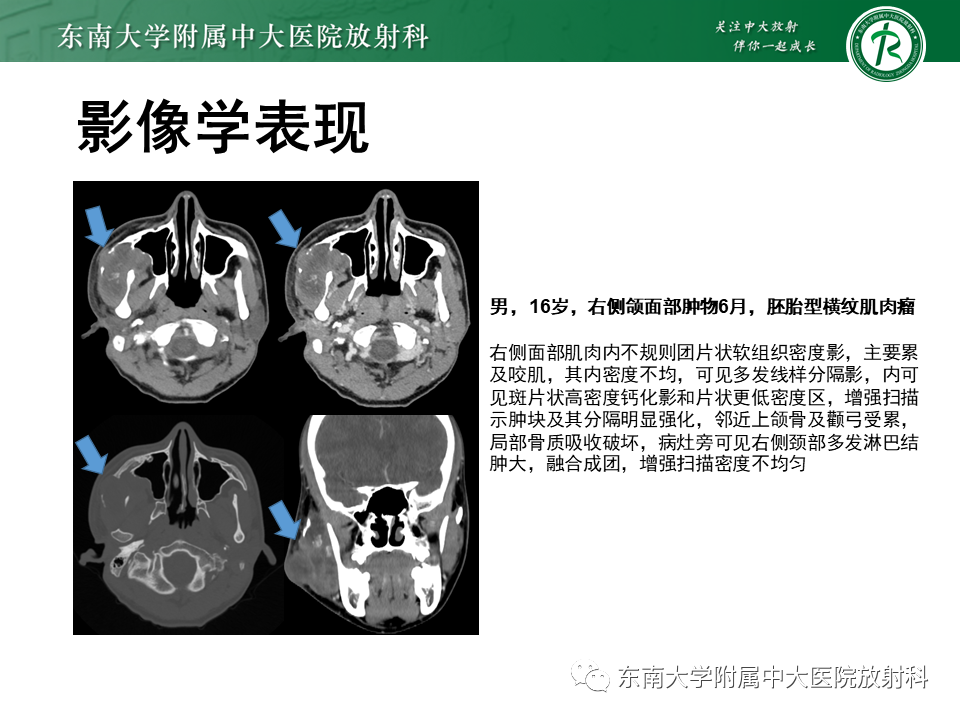 影像PPT - 【病例】颌面部恶性黑色素瘤1例MR影像-20