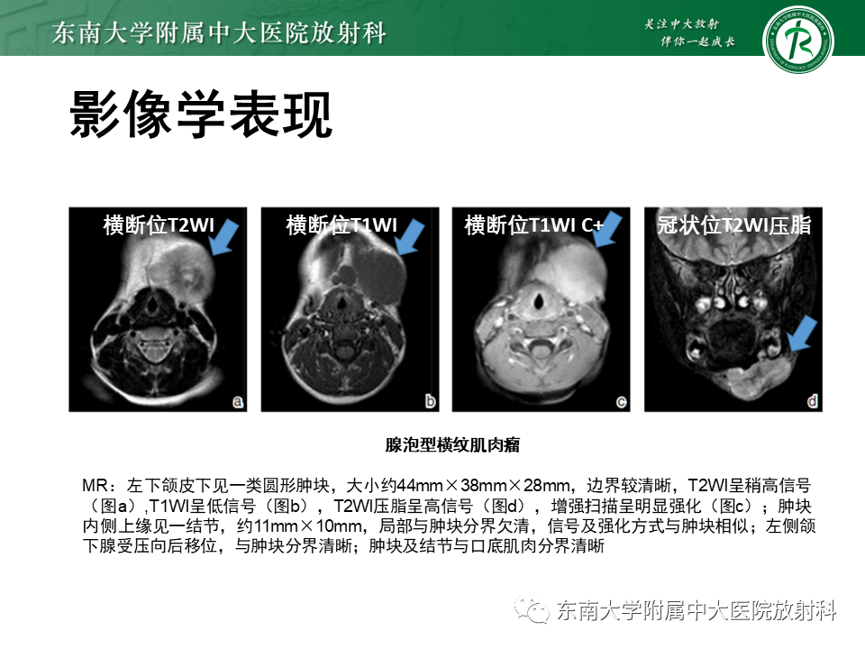 影像PPT - 【病例】颌面部恶性黑色素瘤1例MR影像-21